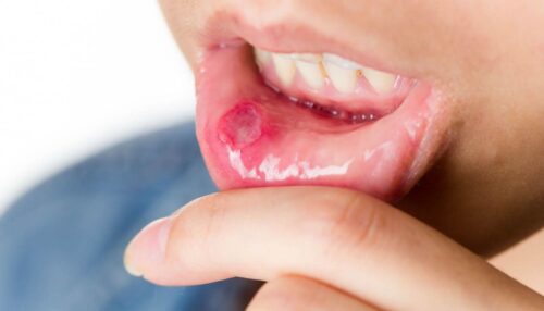 اثر دهانشویه پروپولیس در پیشگیری از موکوزیت ناشی از رادیوتراپی